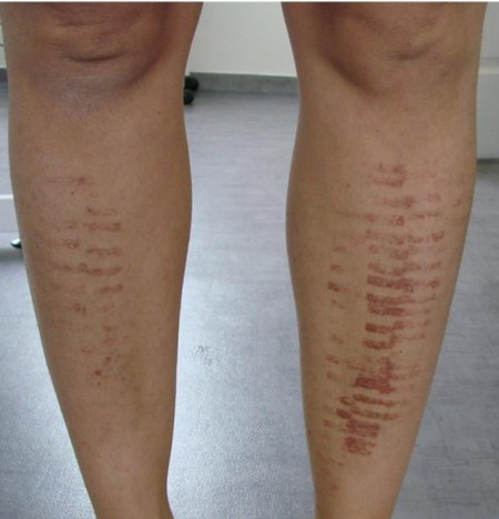 Epilation à lumière pulsée risques
