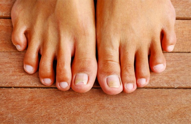 Onychomycose : traitements naturels (mycose des ongles des pieds)