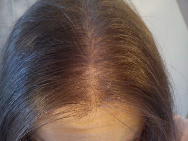 Le Minoxidil 2 pour en finir avec la perte de cheveux chez une femme